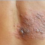 Herpes-Zóster: médico explica por que doença é cada vez mais comum em jovens