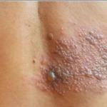 Herpes-Zóster: médico explica por que doença é cada vez mais comum em jovens