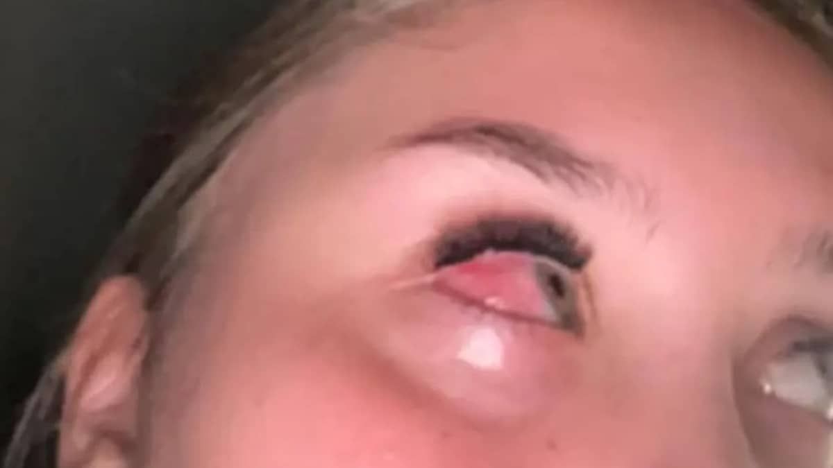 Adolescente fica com os olhos grudados após aplicar extensão de cílios: 'tinha gosma amarela'