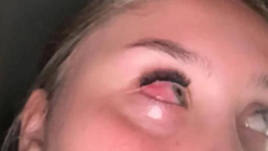 Ela faltou ao trabalho e à escola e não não pode sair ao sol