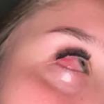 Adolescente fica com os olhos grudados após aplicar extensão de cílios: 'tinha gosma amarela'