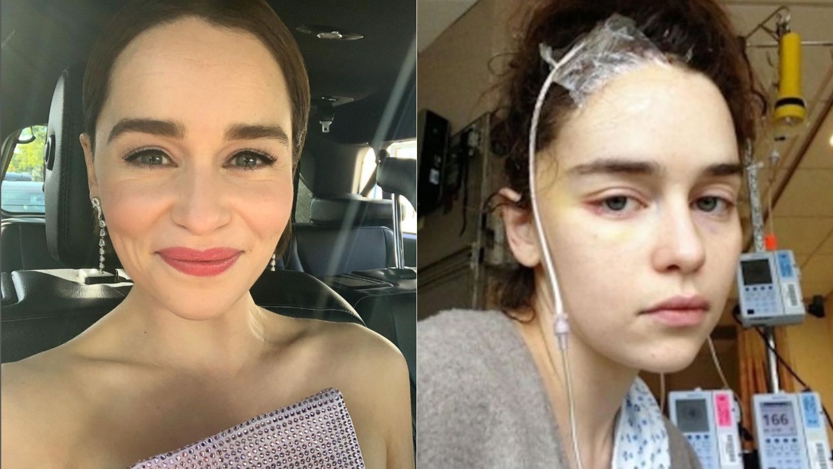 Aneurisma cerebral: entenda doença que fez atriz Emilia Clarke colocar placa de titânio na cabeça