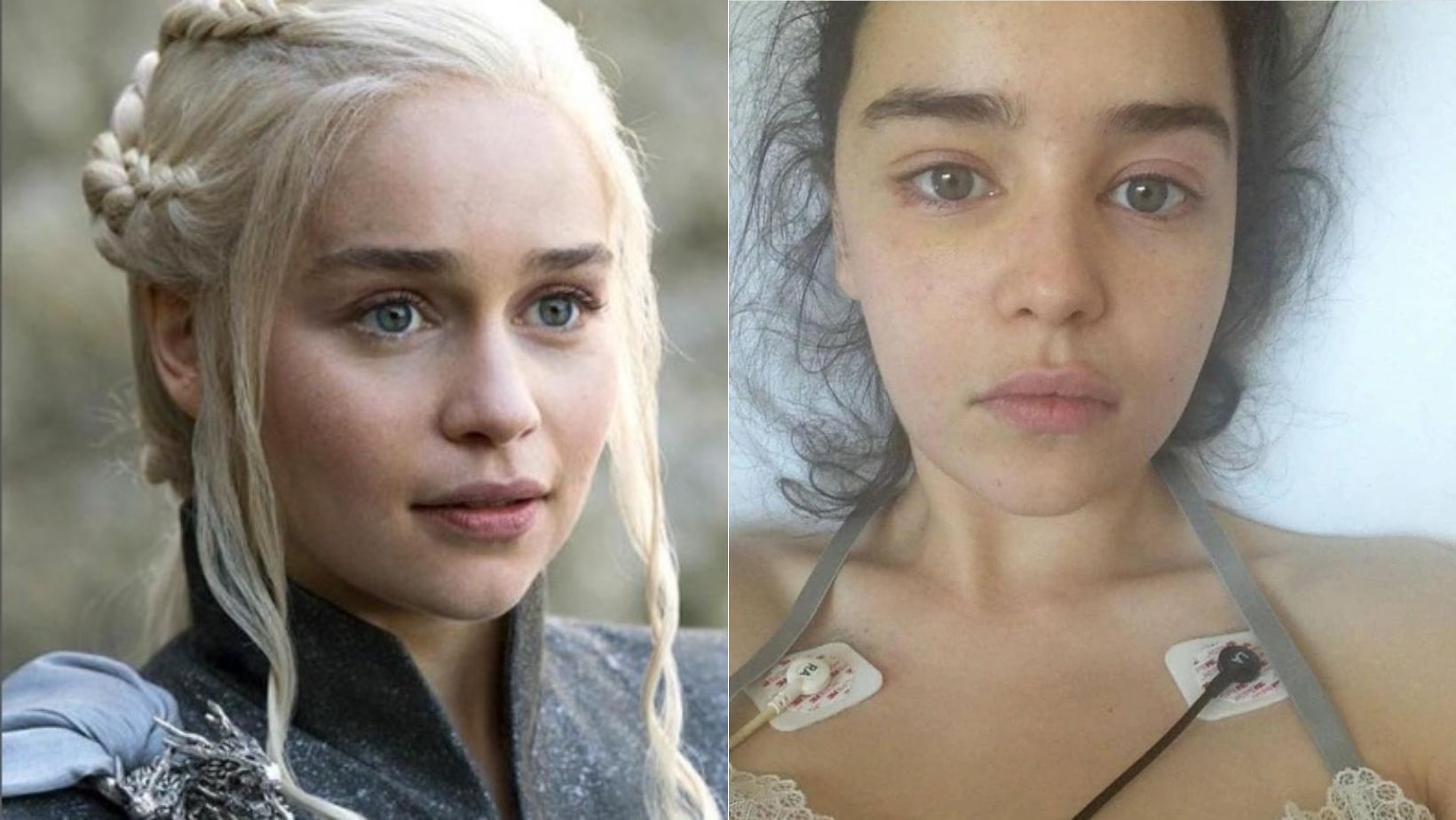 Aneurisma cerebral: entenda diagnóstico da atriz Emilia Clarke de ‘Game of Thrones’