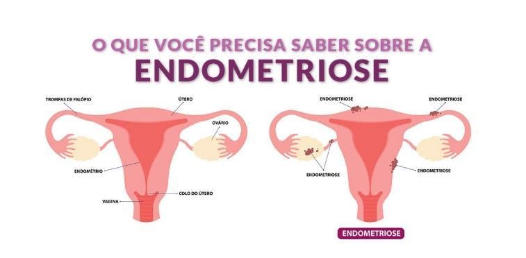 Fabiana de Lemos | Endometriose: uma doença com instalação silenciosa