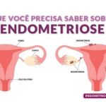 Fabiana de Lemos | Endometriose: uma doença com instalação silenciosa