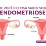 Fabiana de Lemos | Endometriose: uma doença com instalação silenciosa