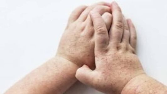 Entenda como identificar a escarlatina