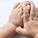 Escolas fechadas por bactéria: entenda o que é escarlatina e a diferença da doença para amigdalite