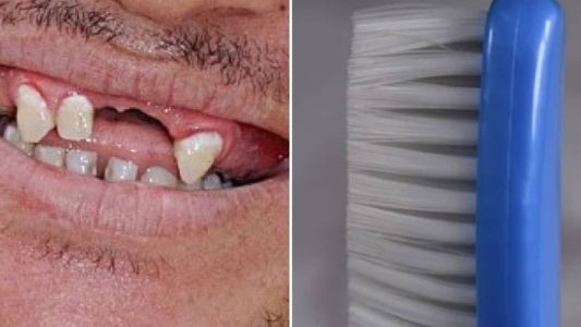 Escova inadequada pode prejudicar a gengiva e o esmalte dos dentes
