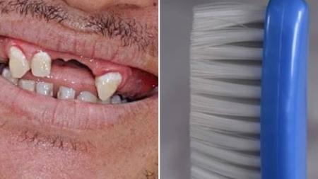Escova inadequada pode prejudicar a gengiva e o esmalte dos dentes