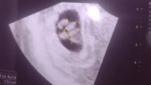 Estatísticas indicam que a chance de uma gravidez natural de quíntuplos é inferior a 1 em 55 milhões