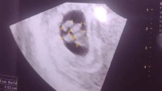Estatísticas indicam que a chance de uma gravidez natural de quíntuplos é inferior a 1 em 55 milhões