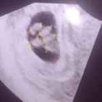 Grávida de quíntuplos faz exame para descobrir a existência de sexto bebê