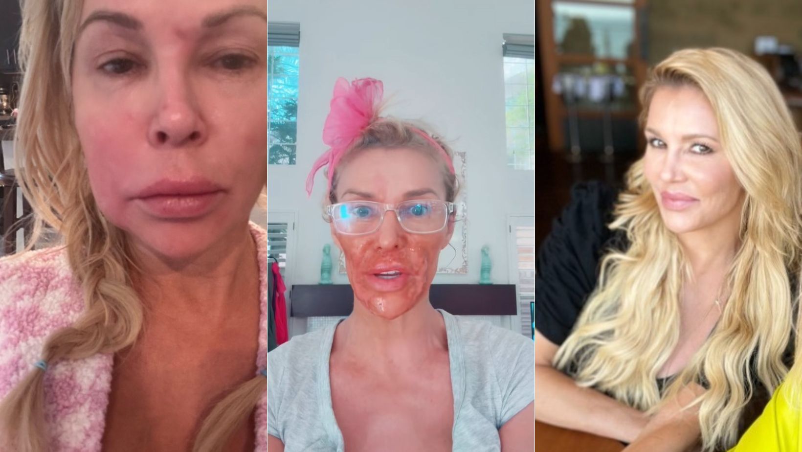 Ex-modelo tem queimaduras no rosto após 'truque de beleza' durante tratamento de parasita facial