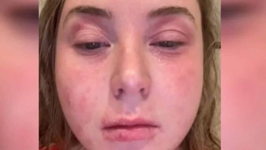 Apenas uma semana depois de retirar as lentes, inglesa sentiu melhoras