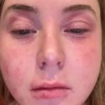 Inglesa tem reação alérgica rara após colocar lentes de contato nos dentes