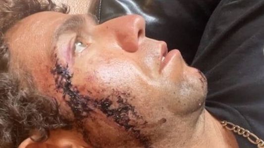 Os dentes do animal feriram da testa até a mandíbula de Mark Summerset