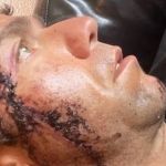 Surfista leva 18 pontos no rosto após mordida de tubarão nos EUA