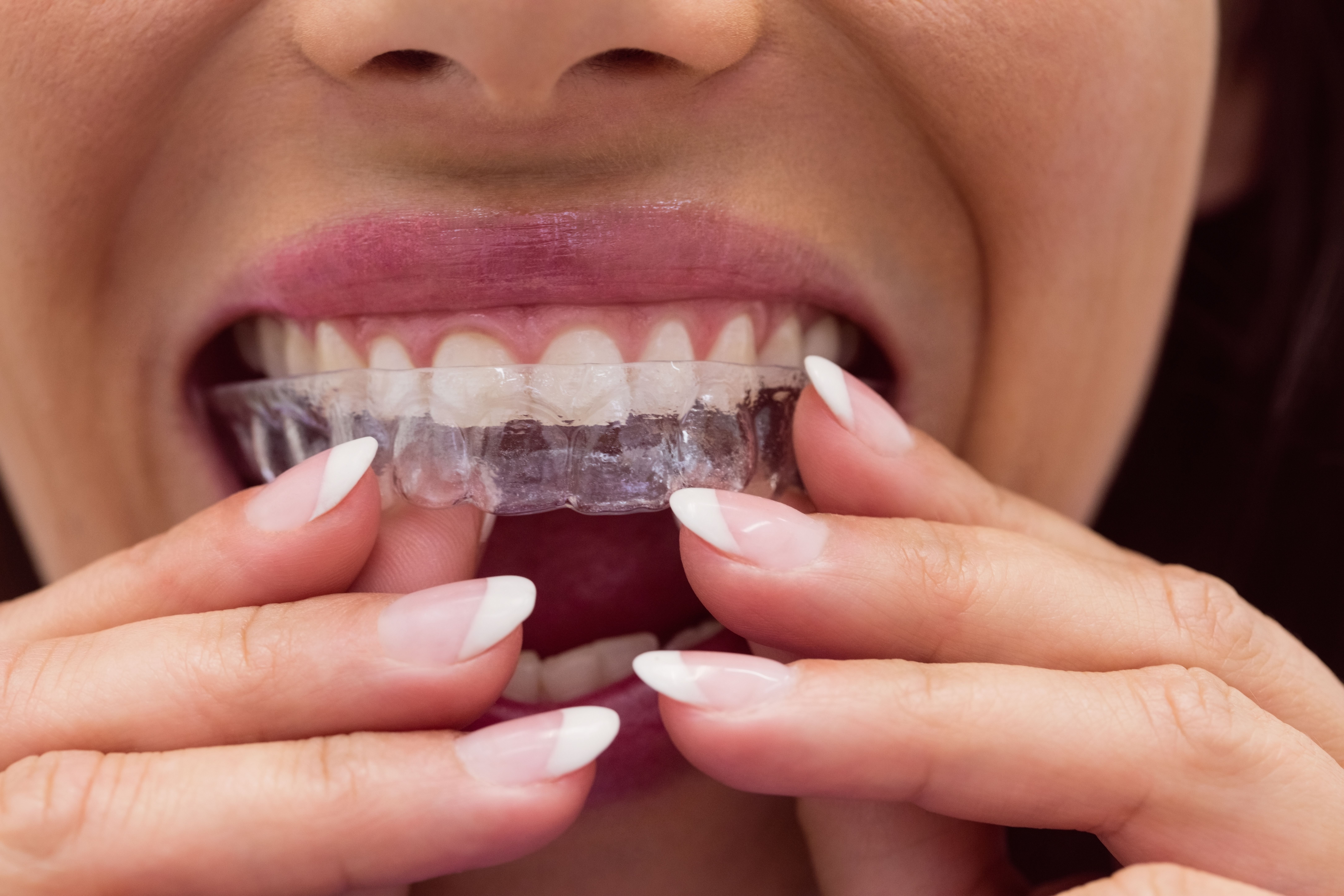 O que é Invisalign? entenda como funciona o alinhador de dentes 'invisível'