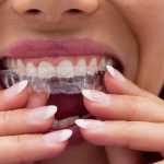 O que é Invisalign? entenda como funciona o alinhador de dentes 'invisível'
