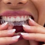 O que é Invisalign? entenda como funciona o alinhador de dentes 'invisível'