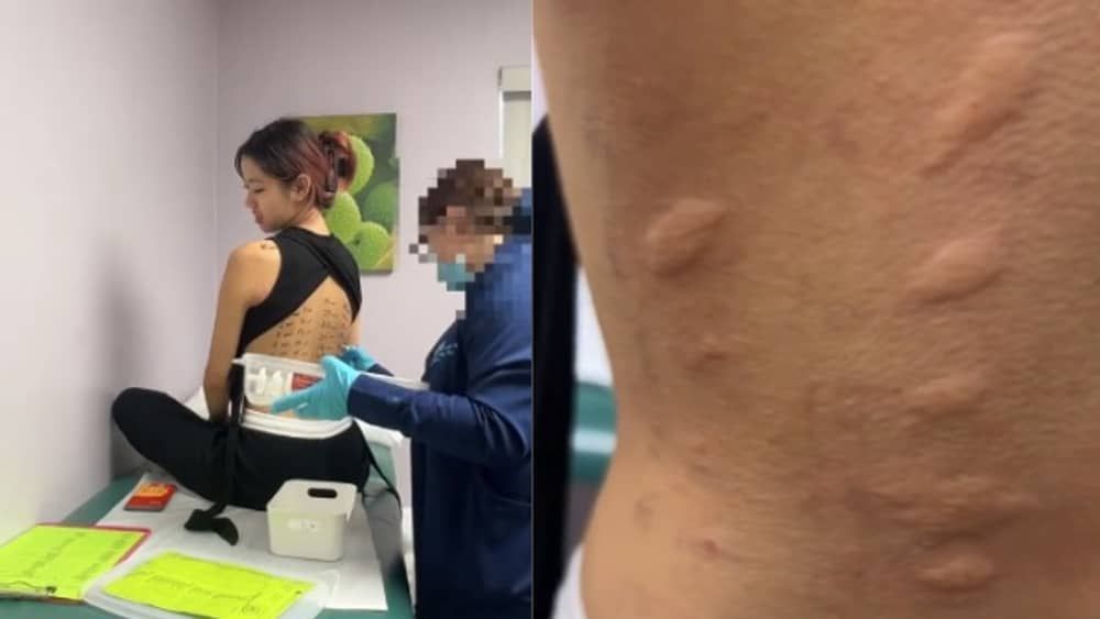 Influenciadora viraliza ao descobrir que é alérgica a mais de 37 alimentos 