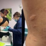 Influenciadora viraliza ao descobrir que é alérgica a mais de 37 alimentos