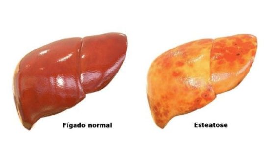 Fígado saudável e o com gordura