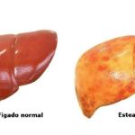 Fabiana de Lemos | Gordura no fígado: risco de cirrose e câncer