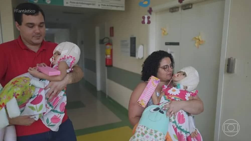 Cirurgias separam gêmeas siamesas brasileiras unidas pelo crânio  