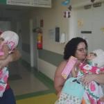 Cirurgias separam gêmeas siamesas brasileiras unidas pelo crânio