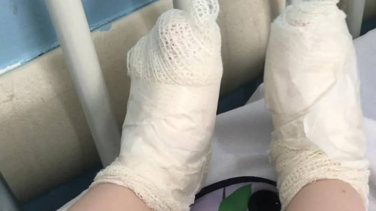 Onda de calor: criança sofre queimaduras de 3º grau após pisar em tampa de ferro em Minas