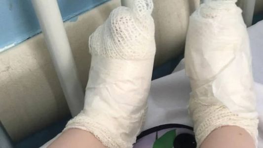 Foto mostra pé da criança enfaixada após queimaduas