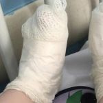 Onda de calor: criança sofre queimaduras de 3º grau após pisar em tampa de ferro em Minas