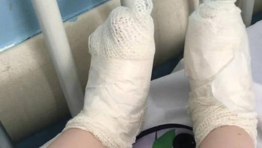 Foto mostra pé da criança enfaixada após queimaduas
