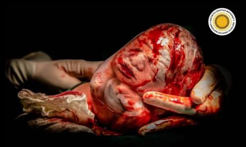 Foto premiada de parto empelicado feita pela fotógrafa mineira Ludmila Gusman Foto Ludmila Gusman