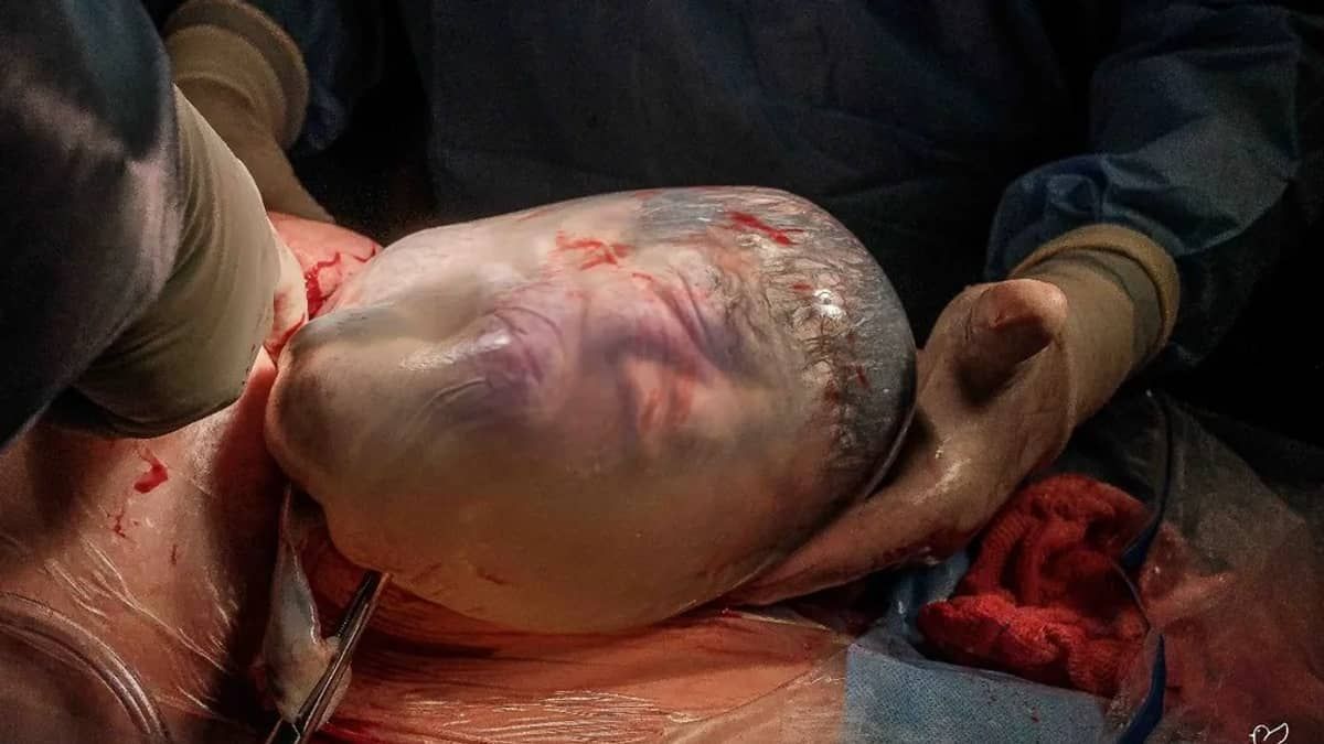 Mulher tem parto de gêmeos, aos 43 anos, e um dos bebês nasce empelicado