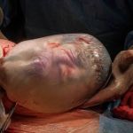 Mulher tem parto de gêmeos, aos 43 anos, e um dos bebês nasce empelicado