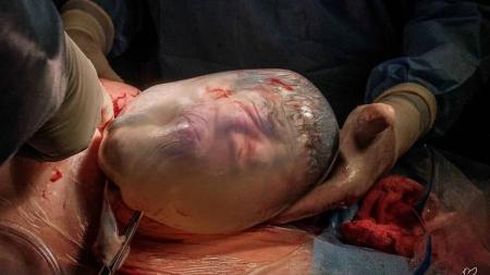 Fotógrafa registra nascimento de bebê empelicado