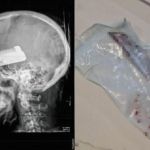 Homem cheira cocaína, crava faca no olho da companheira e vítima perde visão em SC