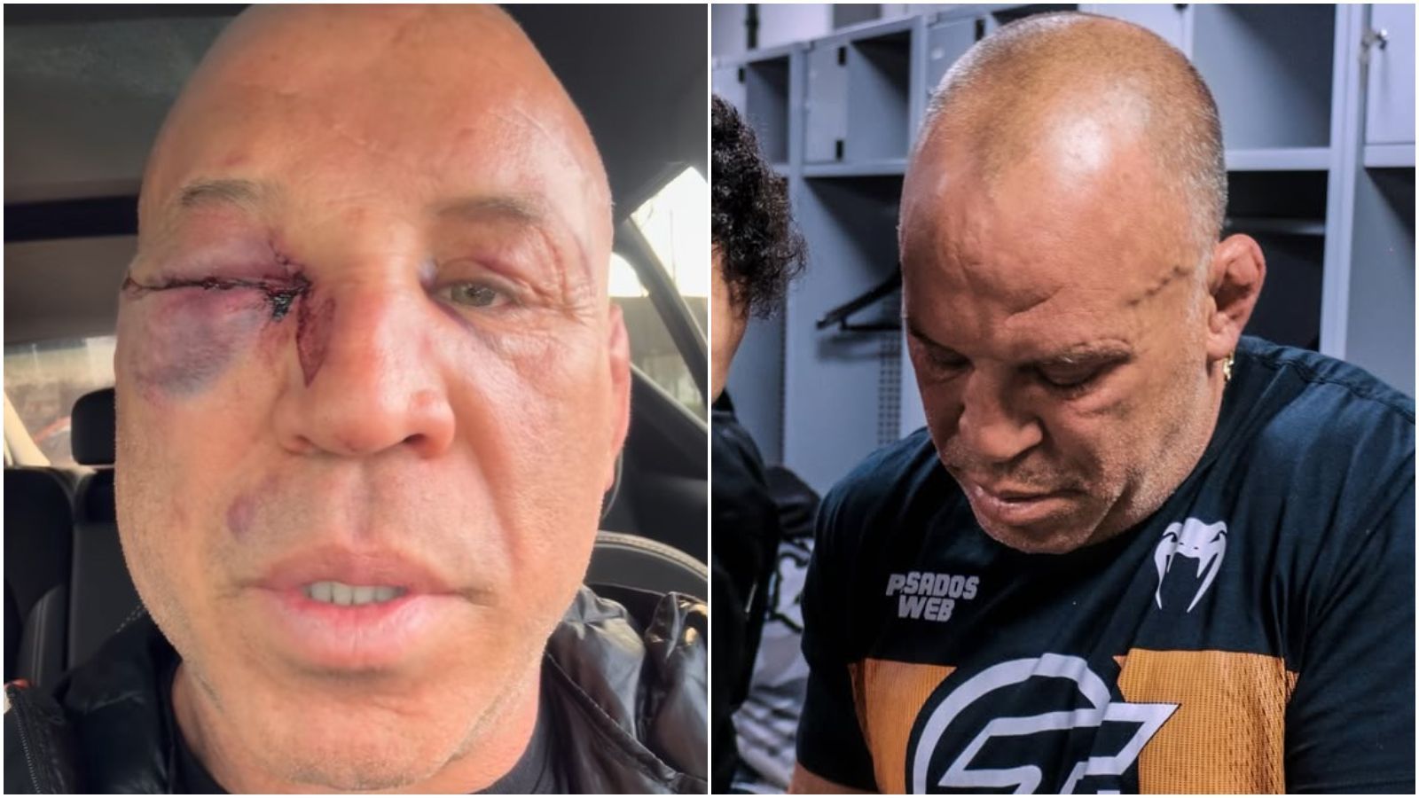 Wanderlei Silva revela qual sequela tem sofrido após socos em luta contra Popó