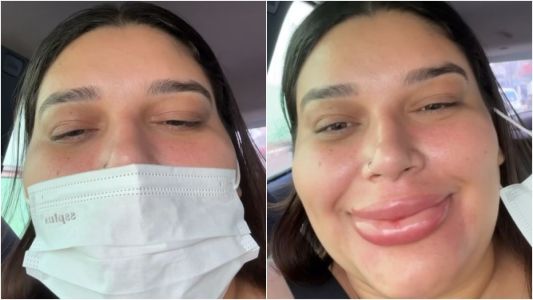 Maquiadora de 27 anos se assusta com inchaço após procedimento nos lábios