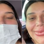 Maquiadora remove preenchimento labial e resultado viraliza nas redes: ‘lindíssima’