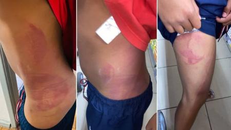 Fotos mostram marcar das agressões que a criança teria sofrido do próprio pai