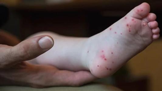 Frequentemente confundida com a doença de Mão, Pé e Boca ou mesmo com Covid-19
