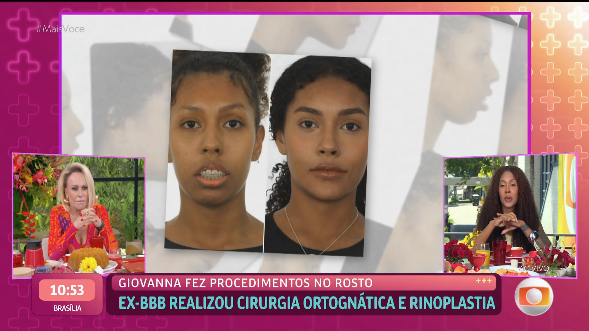 BBB 25: Giovanna diz ter perdido sensibilidade do queixo ao detalhar malformação na face