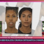 BBB 25: Giovanna diz ter perdido sensibilidade do queixo ao detalhar malformação na face