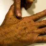 BH tem atendimento gratuito contra câncer de pele neste sábado (2): veja como participar