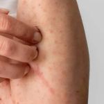 Escarlatina: BH tem 741 casos da doença, 128% a mais que no ano passado