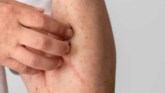 A escarlatina e a amigdalite são transmitidas pela mesma bactéria: a Streptococcus pyogenes.